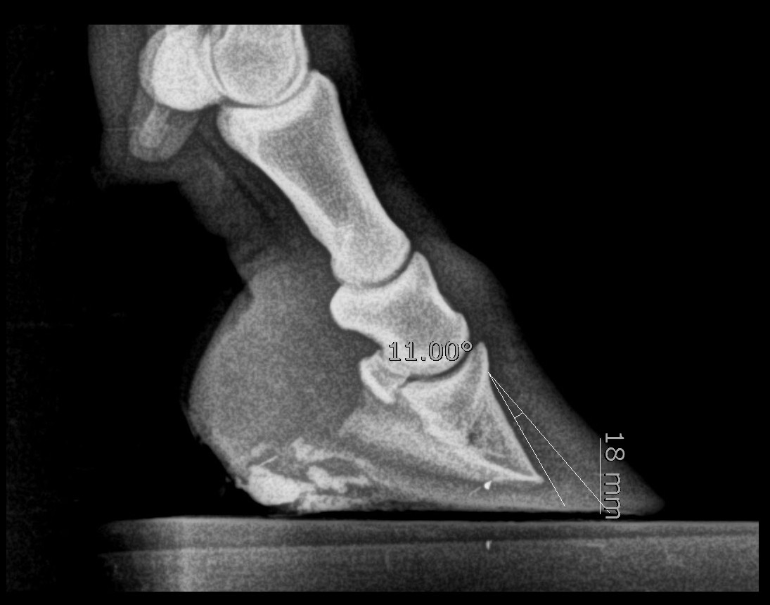 Initial radiograph of Mokka, a pony with chronic laminitis, showing 11° P3 rotation and an 18 mm sole