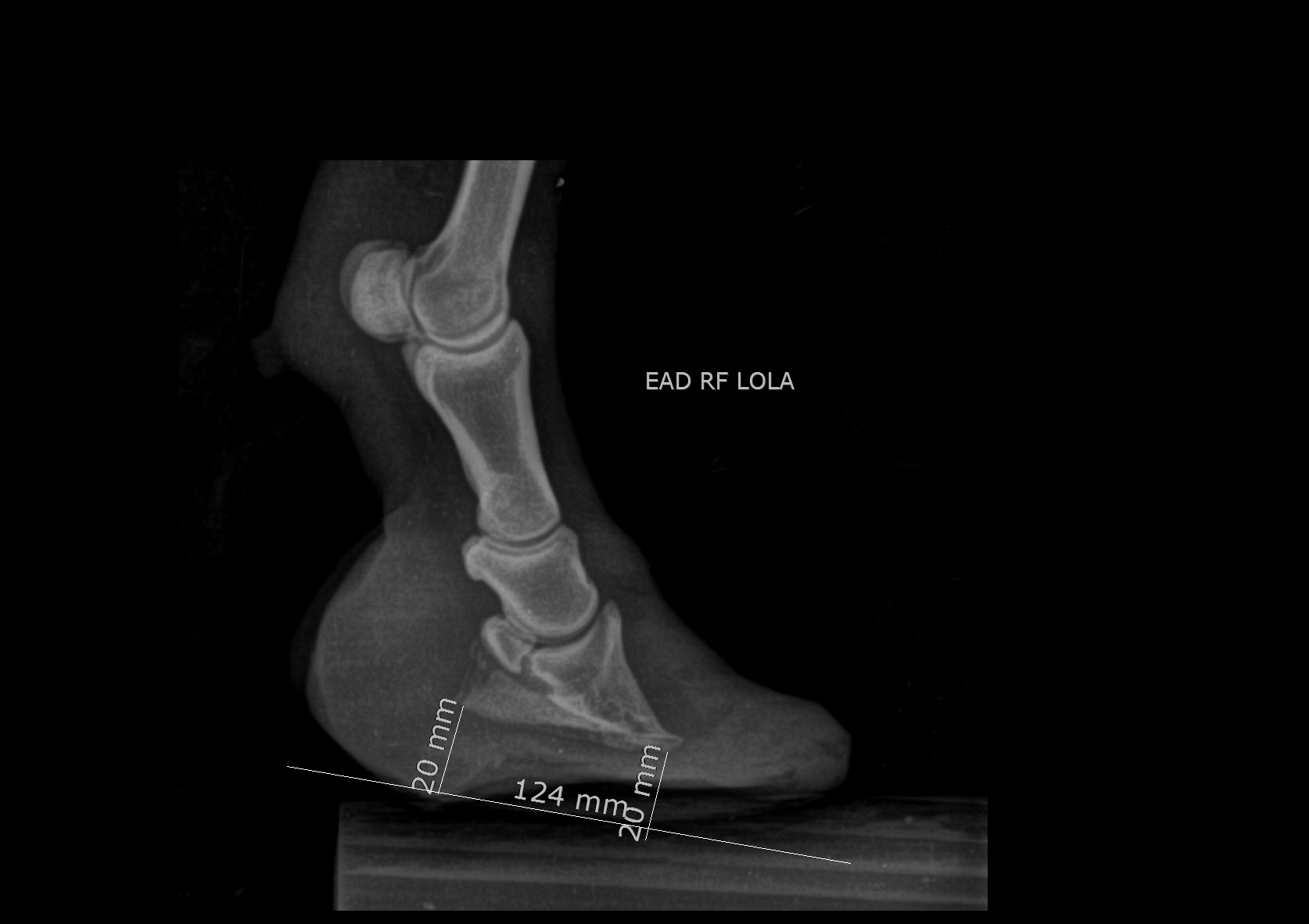 Initial lateromedial radiograph of Lola's right front hoof, a pony with chronic laminitis and a 20 mm sole