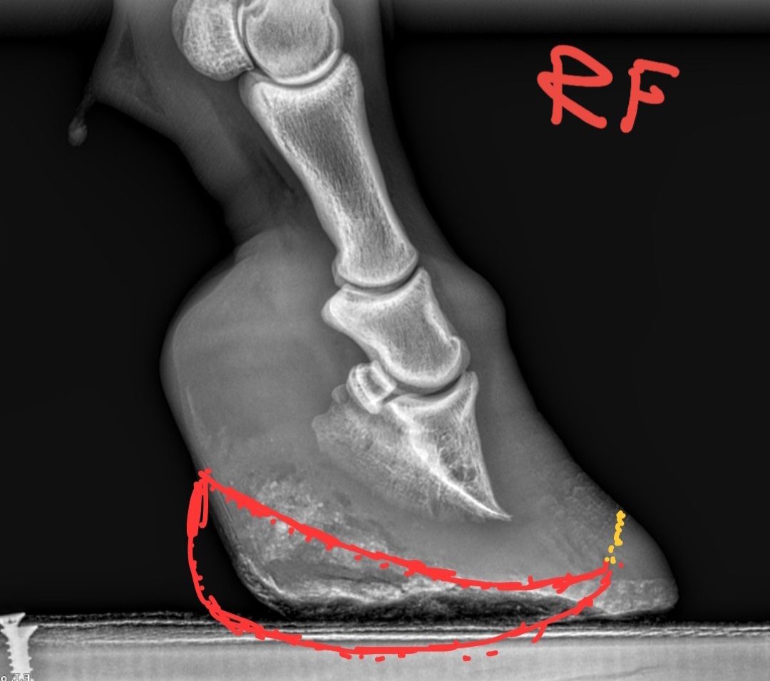 Lateral X-ray of a laminitic hoof with the 3D horseshoe outline drawn in red